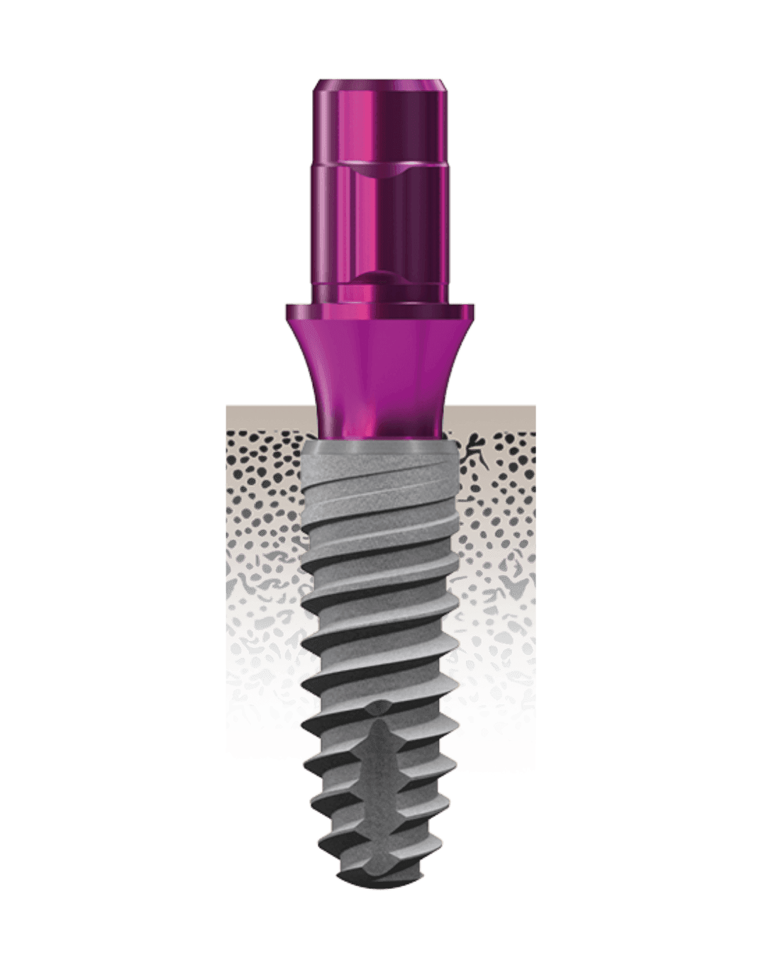 copaSKY implantátumrendszer – Hero image